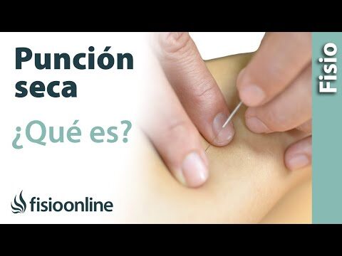 Acupuntura: Soluci&oacute;n Efectiva para Contracturas