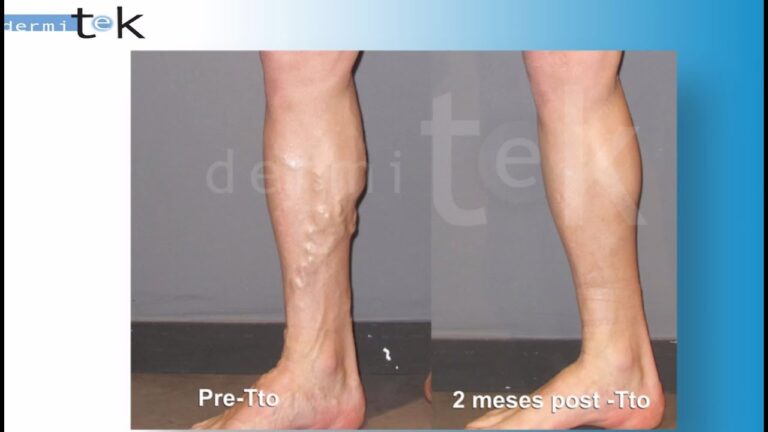Beneficios de la Cirugía Láser en Varices