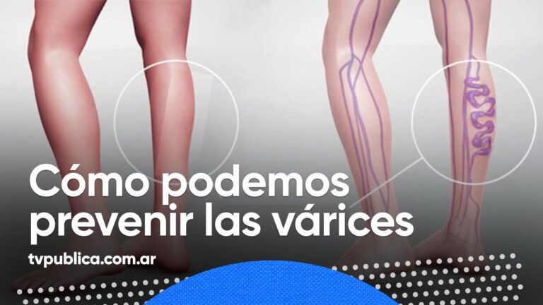 Alivio Efectivo del Dolor en las Piernas por Várices